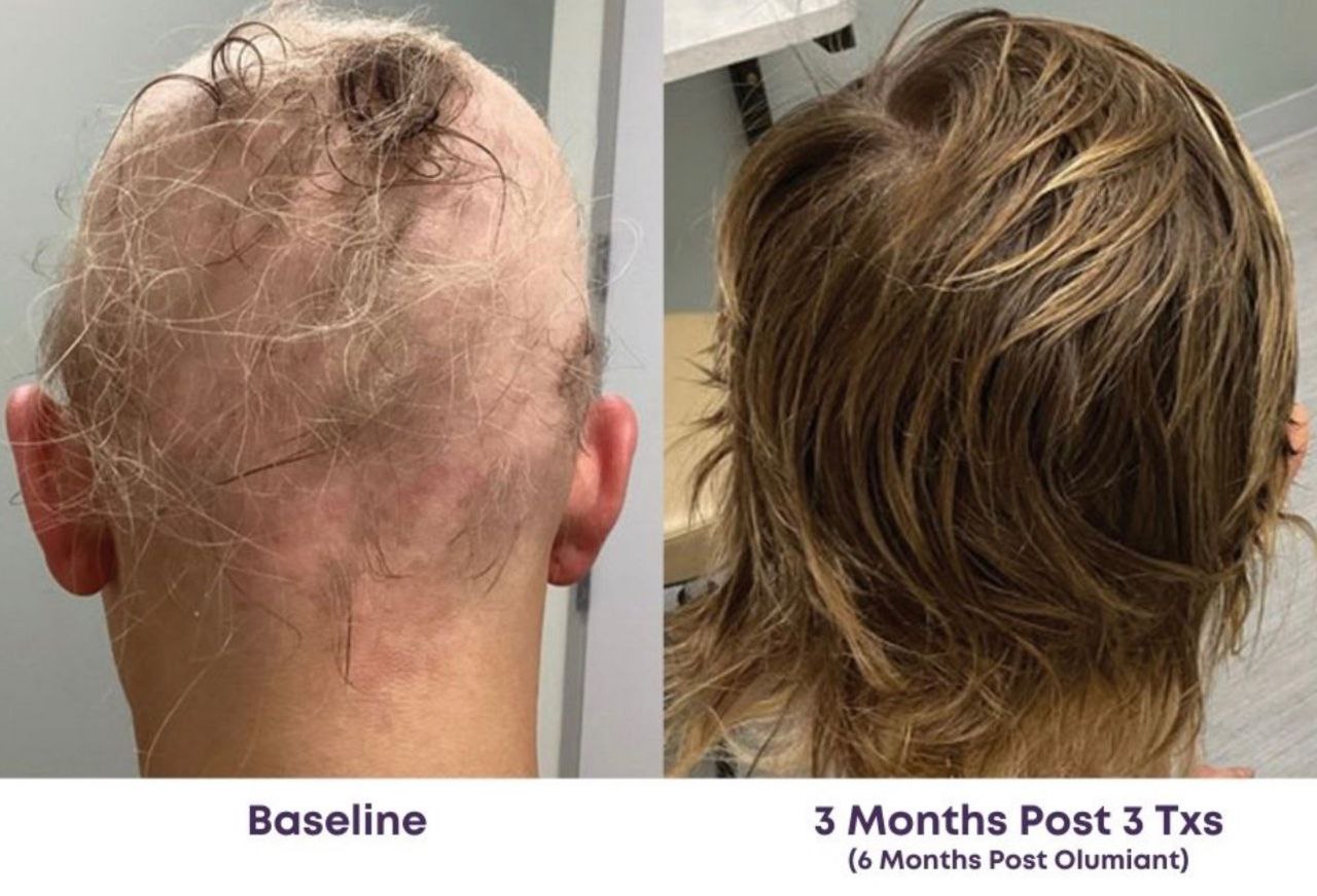 Before and After — male, 3 months