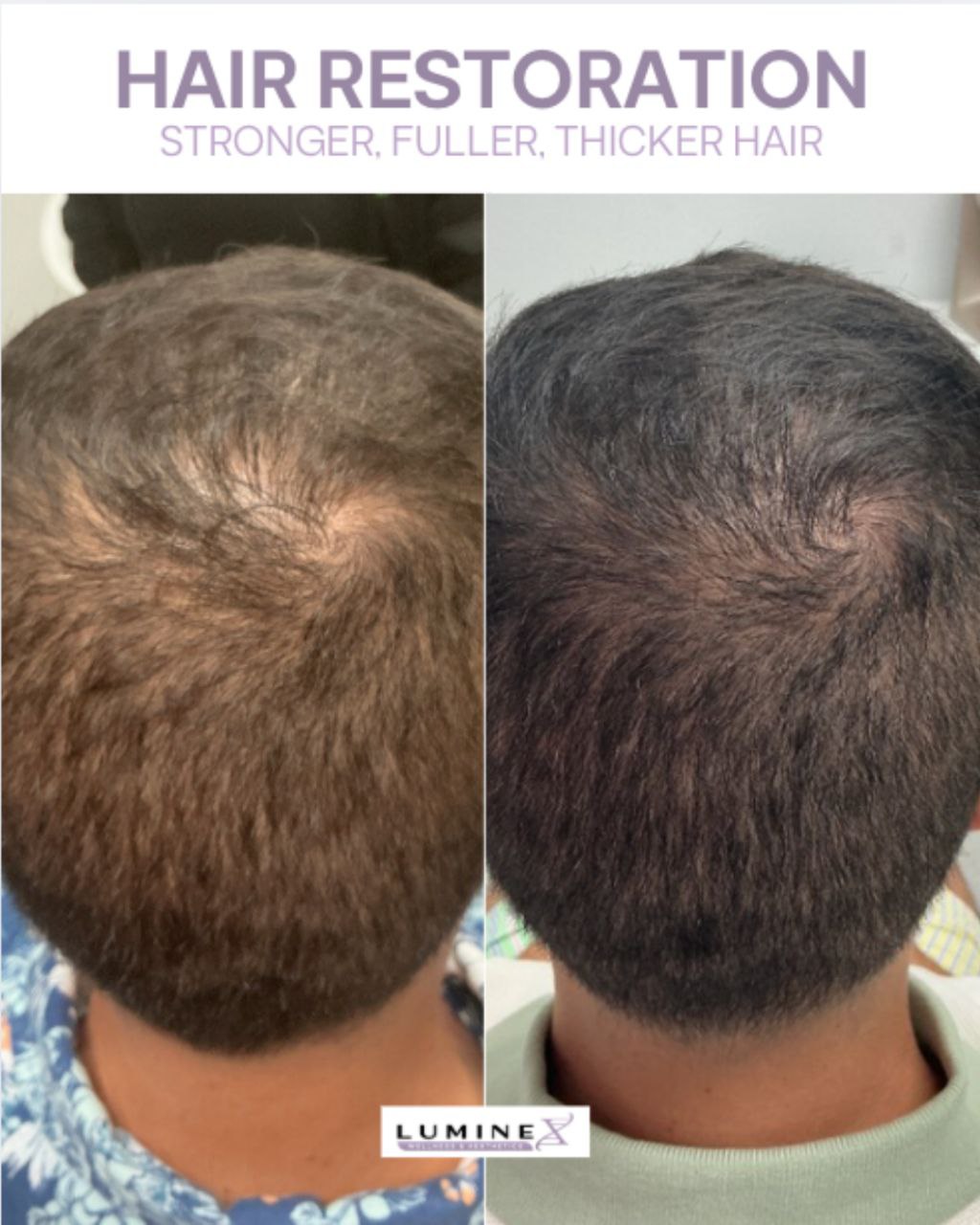 Before and After — crown restoration